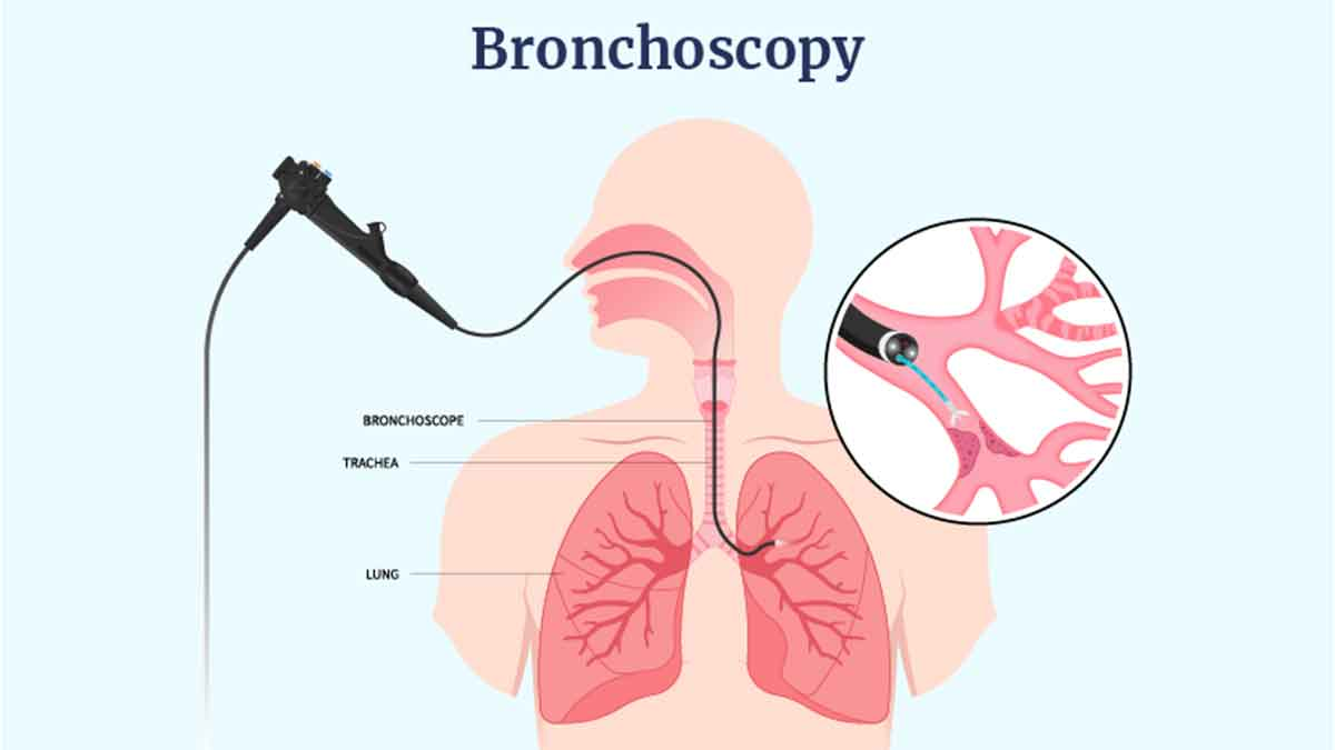 گزارش‌دهی برونکوسکوپی
