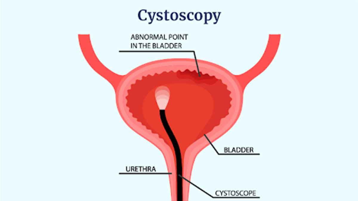 گزارش‌دهی سیستوسکوپی