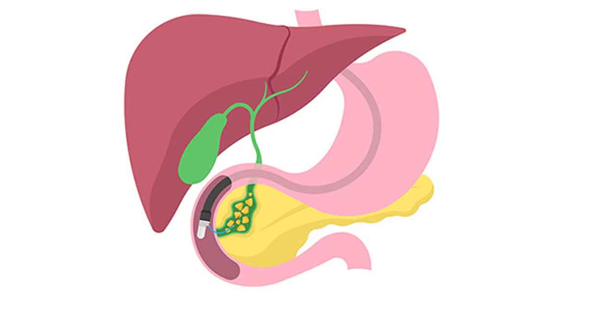 گزارش‌دهی ERCP