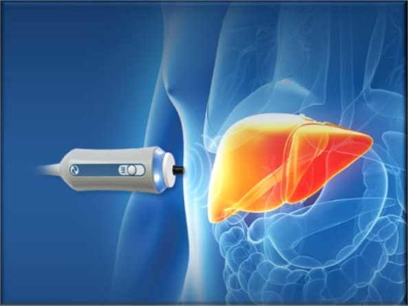 گزارش‌دهی الاستوگرافی کبد