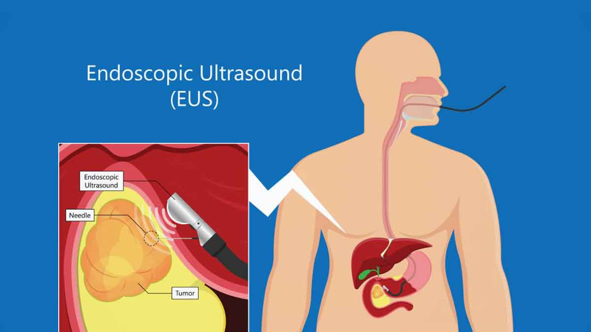 گزارش‌دهی آندوسونوگرافی